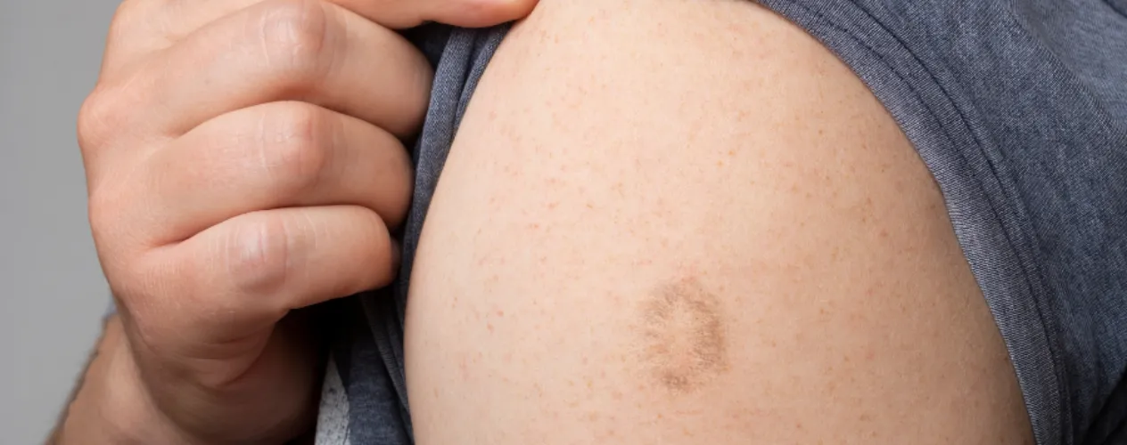 Vaccine scar on arm