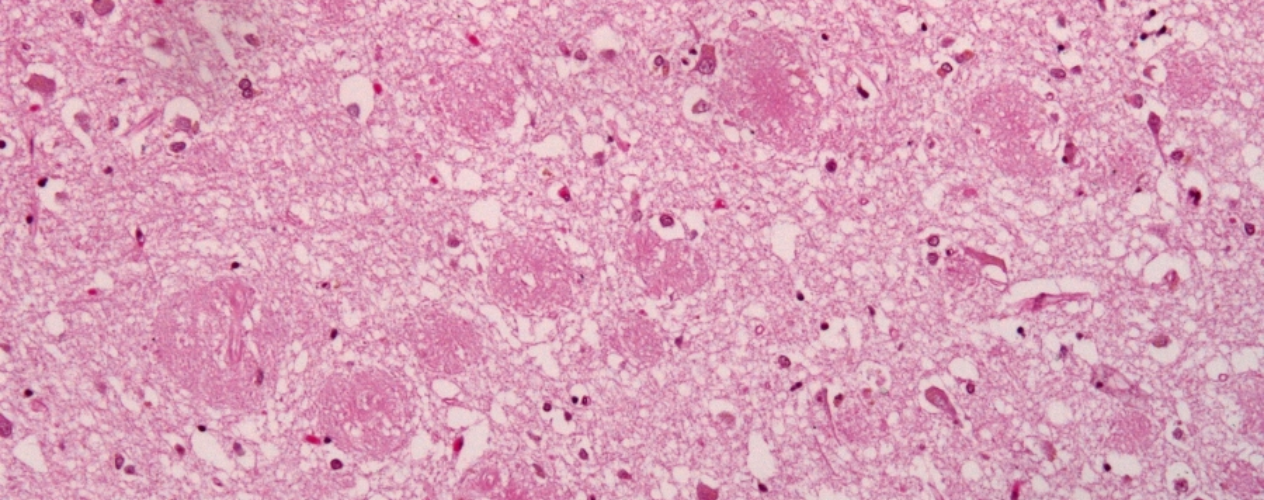 Amyloid plaques alzheimer disease HE stain