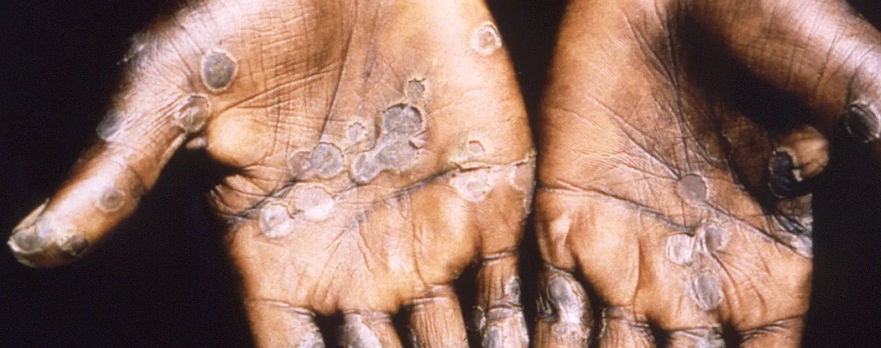 Mpox on hands_US CDC PHIL image