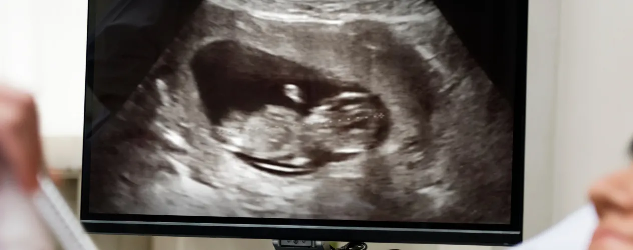 Exposure to intense wildfire smoke during pregnancy may be linked to increased likelihood of autism