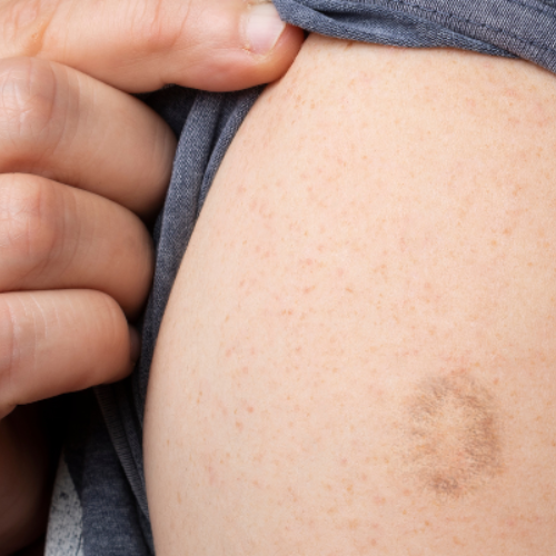 Vaccine scar on arm