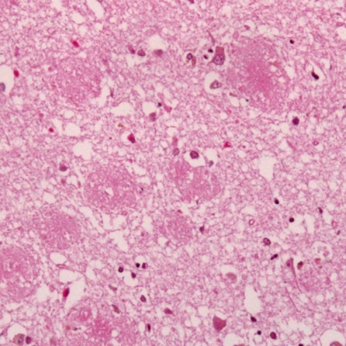 Amyloid plaques alzheimer disease HE stain