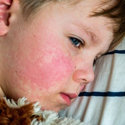 123rf_Measles_rash