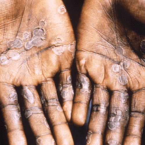 Monkeypox on hands_US CDC PHIL image