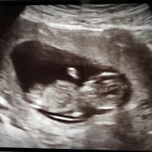 Exposure to intense wildfire smoke during pregnancy may be linked to increased likelihood of autism